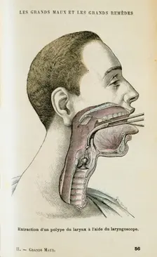 Using a laryngoscope to aid the removal of a polyp from the throat, c1890. Creator: Unknown