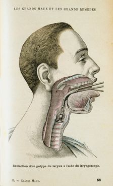 Using a laryngoscope to aid the removal of a polyp from the throat, c1890