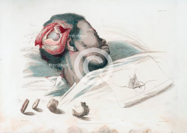 View of wound in skull after trephination and removal of shattered bone piece at bottom left, 1821. Artist: Thomas Landseer