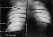 X-Ray of Roosevelt [shows bullet], 1912. Creator: Bain News Service
