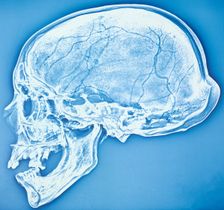 Xeroradiograph of the bathrocranic skull. Creator: Unknown