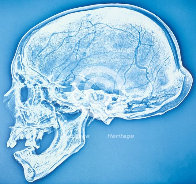 Xeroradiograph of the bathrocranic skull. Creator: Unknown.